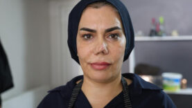 burnu-kirildi-dort-operasyon-gecirdi-her-ameliyattan-sonra-yeni-bir-burun-ortaya-cikti.jpg