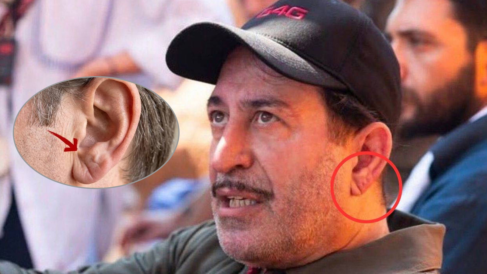 Cem Yılmaz’ın rahatsızlığı sonrası gündeme geldi: ‘Frank işareti’ kalp krizinin sessiz belirtisi mi?