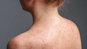 Prof. Dr. Kara'dan kızamık uyarısı! Bir kişi 18 kişiye bulaştırabilir